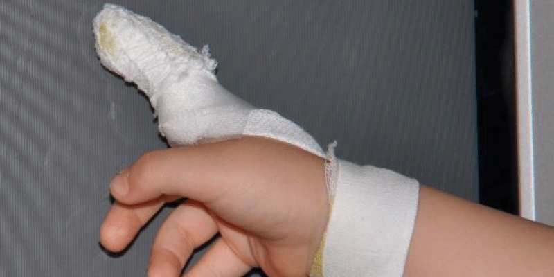 Băng bó vết thương để tránh vết thương bị nhiễm trùng do vi khuẩn xâm nhập (Ảnh: Sưu tầm internet)