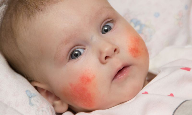 Trẻ bị dị ứng với thành phần của sữa mẹ. (Ảnh: Nguồn Internet)