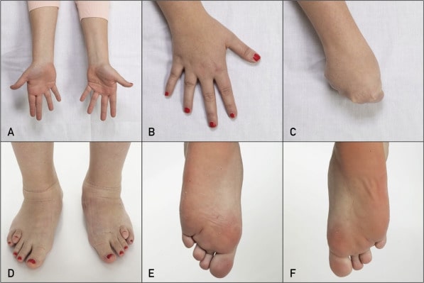 Pseudopseudohypoparathyroidism là từ thường được dùng trong y học (Ảnh: Sưu tầm Internet)