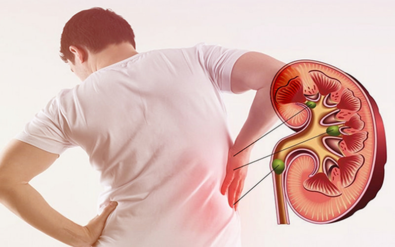 Sử dụng vitamin C không đúng chỉ dẫn tăng nguy cơ sỏi thận. (Ảnh: Sưu ầm Internet)