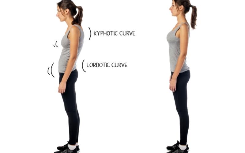 Vẹo cột sống bao gồm nhiều loại khác nhau. (Ảnh: Sưu tầm Internet)