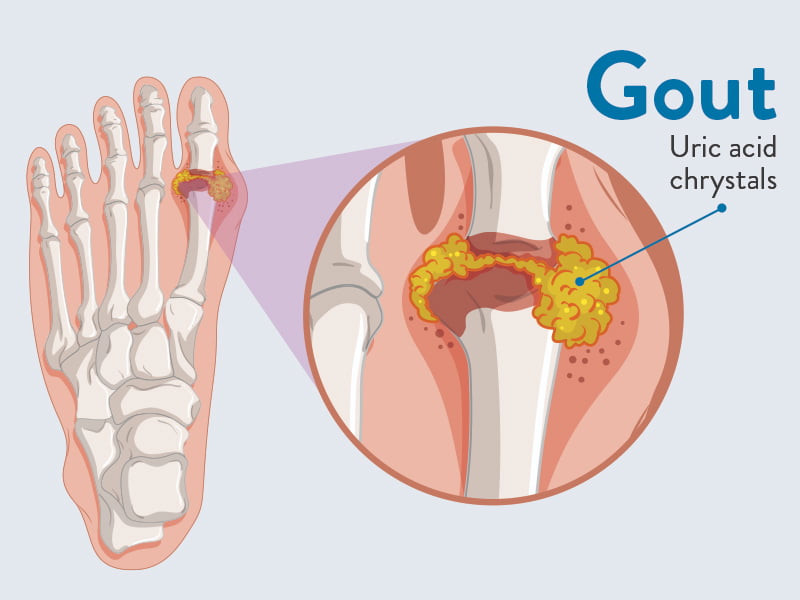 Những người bổ sung vitamin C có nguy cơ mắc bệnh gout thấp hơn tới 44% so với những người khác. (Ảnh: Sưu tầm Internet)