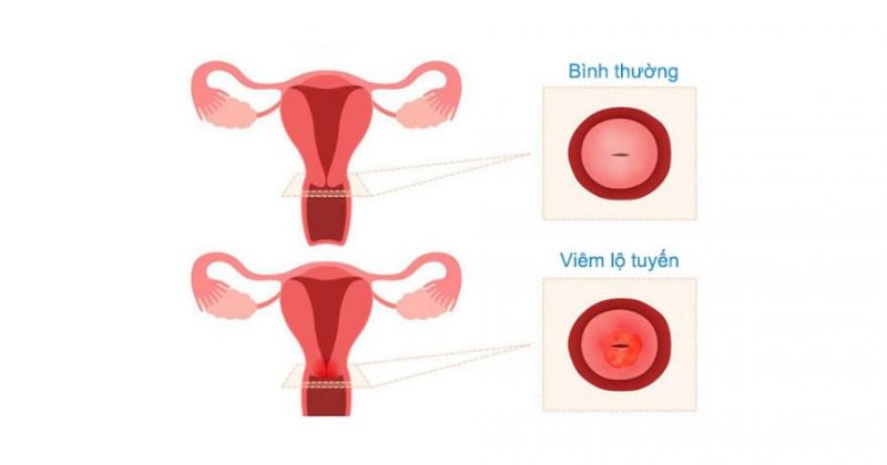 Viêm lộ tuyến tử cung ảnh hưởng đến sức khỏe vùng kín (Ảnh: Sưu tầm Internet)