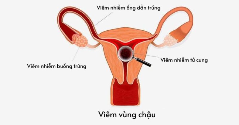 Viêm vùng chậu sau sinh khiến vùng kín có mùi hôi (Ảnh: Sưu tầm Internet)