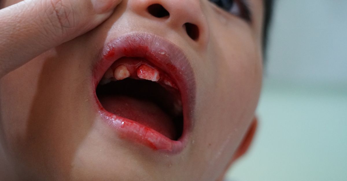 Hướng dẫn cách xử lý khi trẻ bị ngã rách môi trong