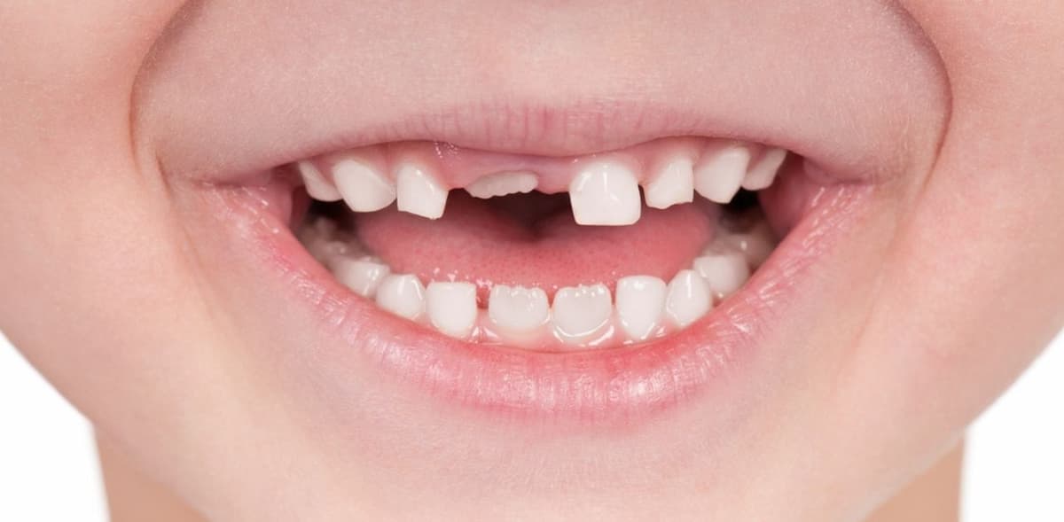 Trẻ rụng răng lâu mọc: nguyên nhân, hậu quả và cách điều trị
