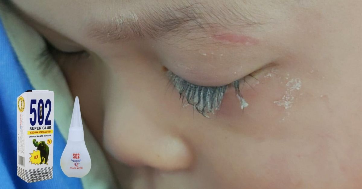 10 cách sơ cứu bé bị bỏng keo 502 cha mẹ cần biết