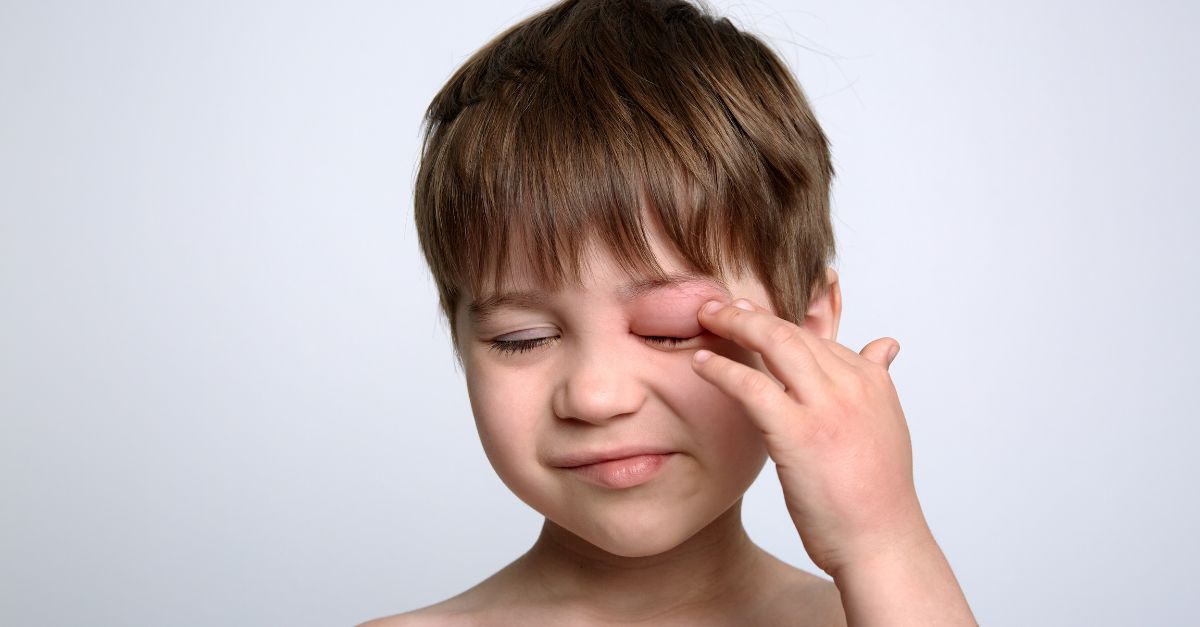 Trẻ bị côn trùng cắn sưng mắt cần xử lý như thế nào?