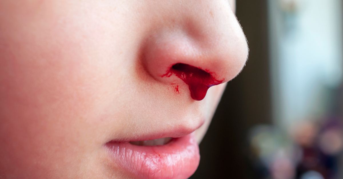 Cảnh giác khi trẻ bị ngã đập đầu chảy máu mũi