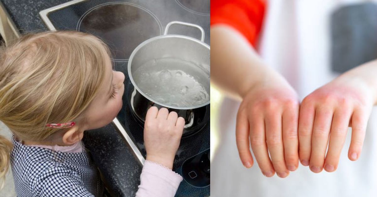 Cách xử lý khi trẻ bị bỏng hơi nước tại nhà cha mẹ cần biết