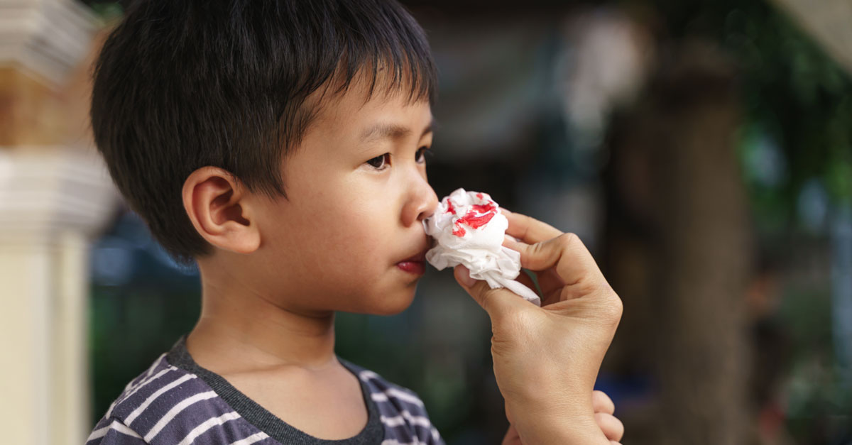 Trẻ bị chảy máu cam là thiếu chất gì? Dinh dưỡng nào cần bổ sung cho trẻ?