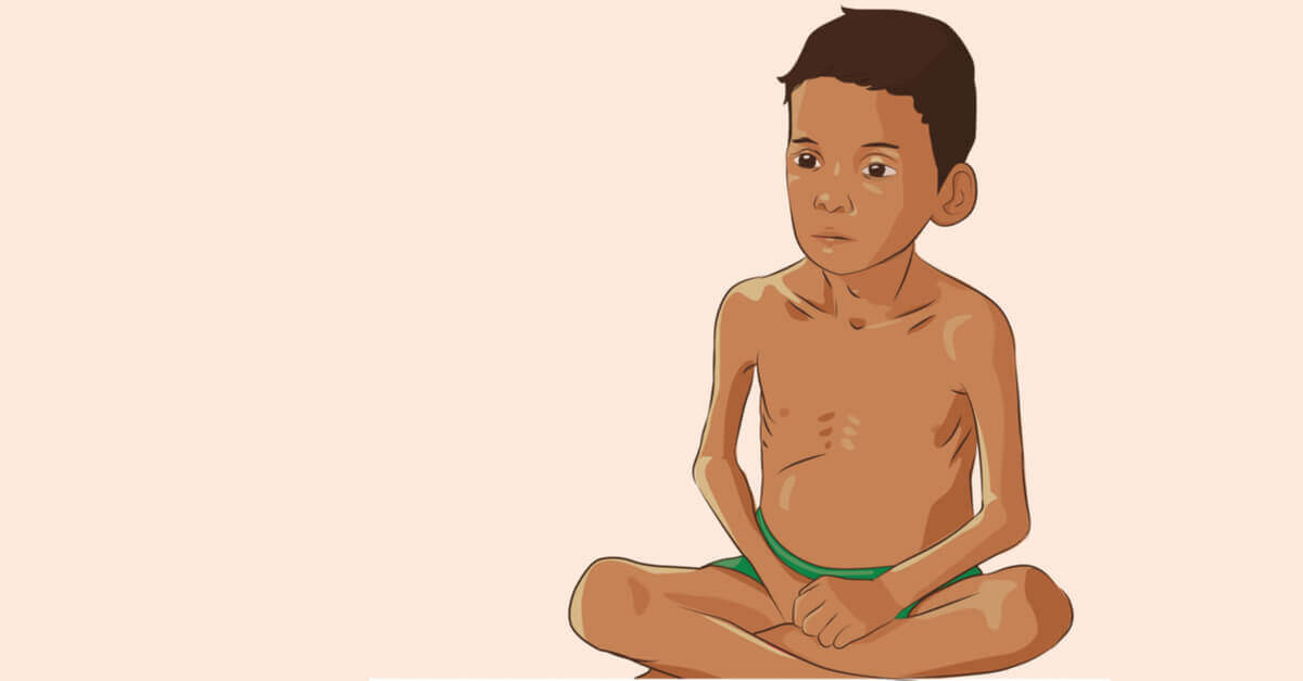 Cách nhận biết suy dinh dưỡng thể teo đét (Marasmus) ở trẻ