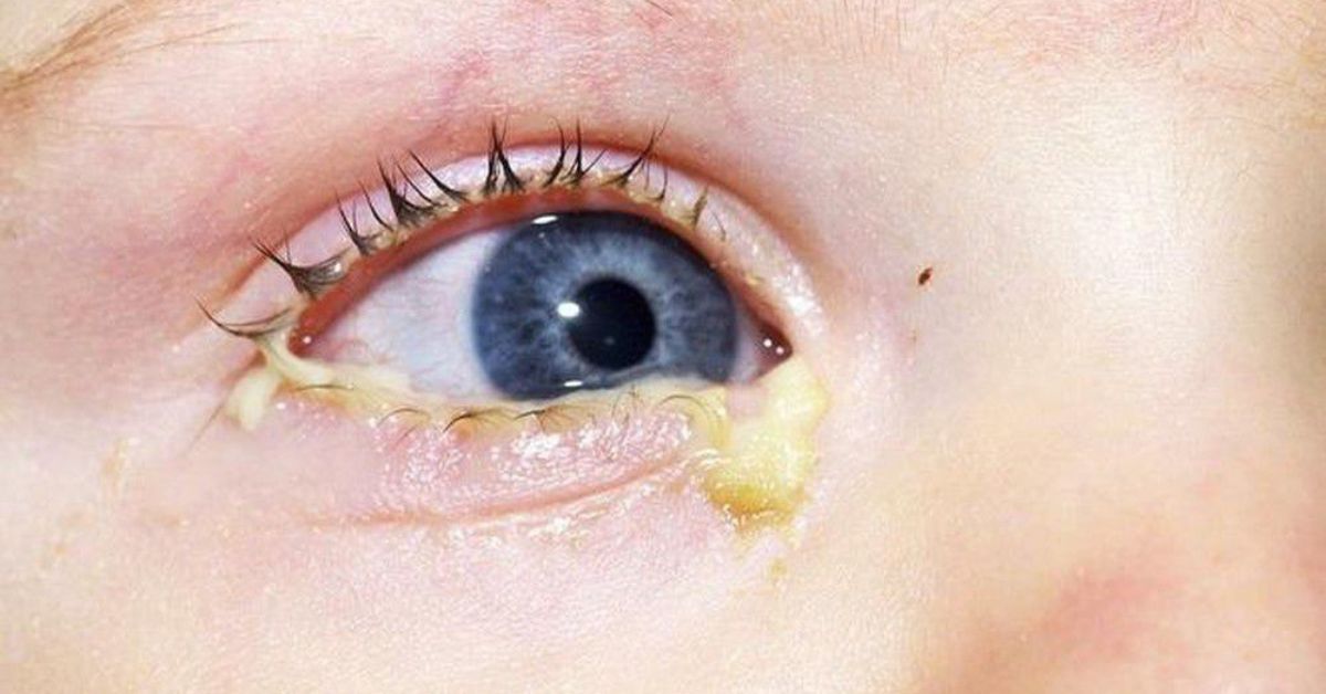 [Cảnh báo] Nguy hiểm khi nhỏ sữa mẹ vào mắt trẻ sơ sinh có thể gây mù