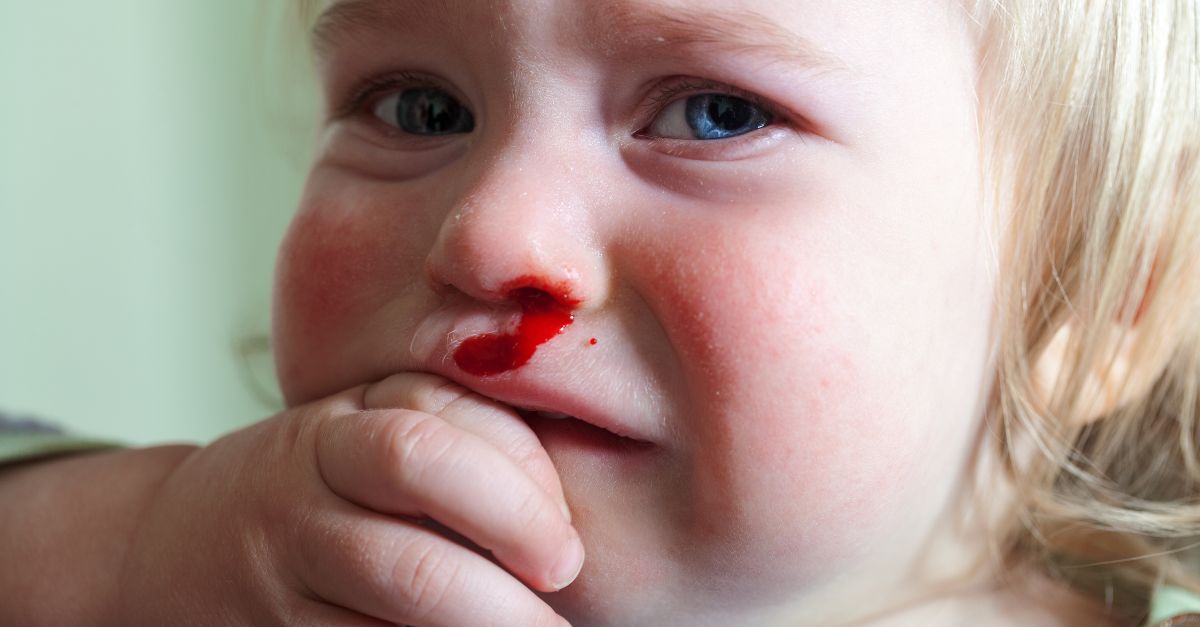 Trẻ bị ngã đập mũi- Cách xử lý các chấn thương mũi khi trẻ bị ngã